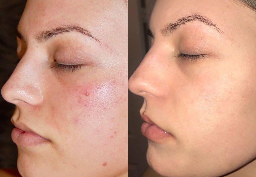 cosmetic clinic in thanjavur for chemical peeling