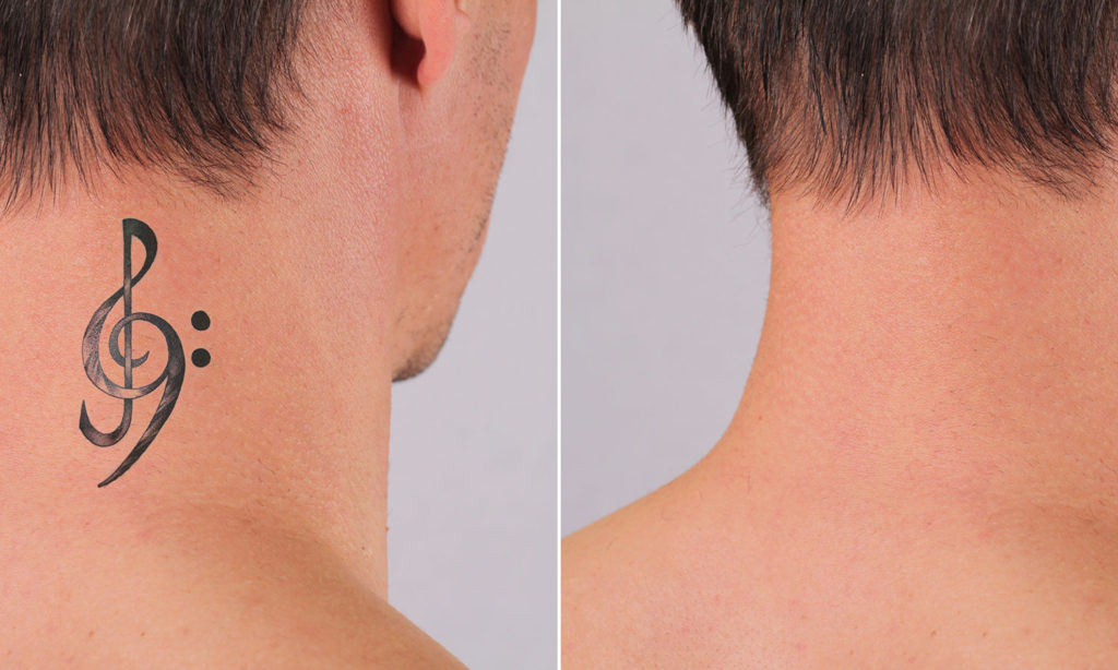 best-tattoo-removal-in-thanjavur